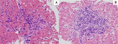 Case Report: A Case of Acute Cellular Rejection Due to Atopic Dermatitis Exacerbation 3 Years After Heart Transplantation